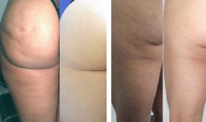 UltraSlim Treatment - Cellulite Treatment