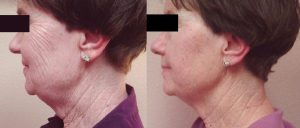 UltraSlim® Treatment - Non-Invasive Facelift